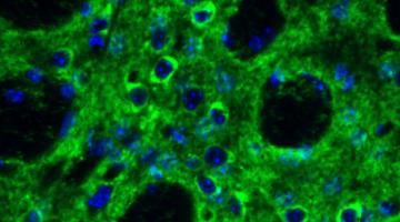 Researchers are studying the role of the immune system molecule IL-6 in Huntington's disease, which leads to neurodegeneration in a region of the brain called the striatum. In this figure from a prior study, green staining highlights Stat3 in th...