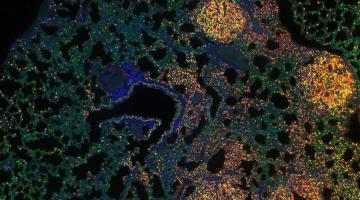 MIT researchers have analyzed how epigenomic modifications change as tumors evolve. This image shows a lung with tumors that researchers collected with multiplexed immunohistochemistry.Image: Isabella Del Priore and Lindsay LaFave